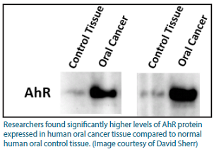 Gel image from the lab showing much higher expression of AhR in oral cancer tissue compared to normal tissue.